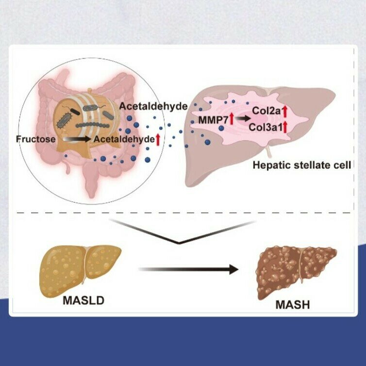 肝病防治新突破：揭秘高糖饮食伤肝机制，开发靶向“清醛”益生菌护肝